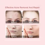 hydrocolloid patches acne