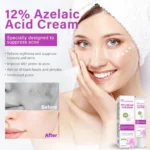azelaic acid cream