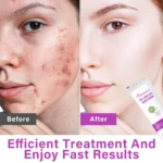 azelaic acid face cream