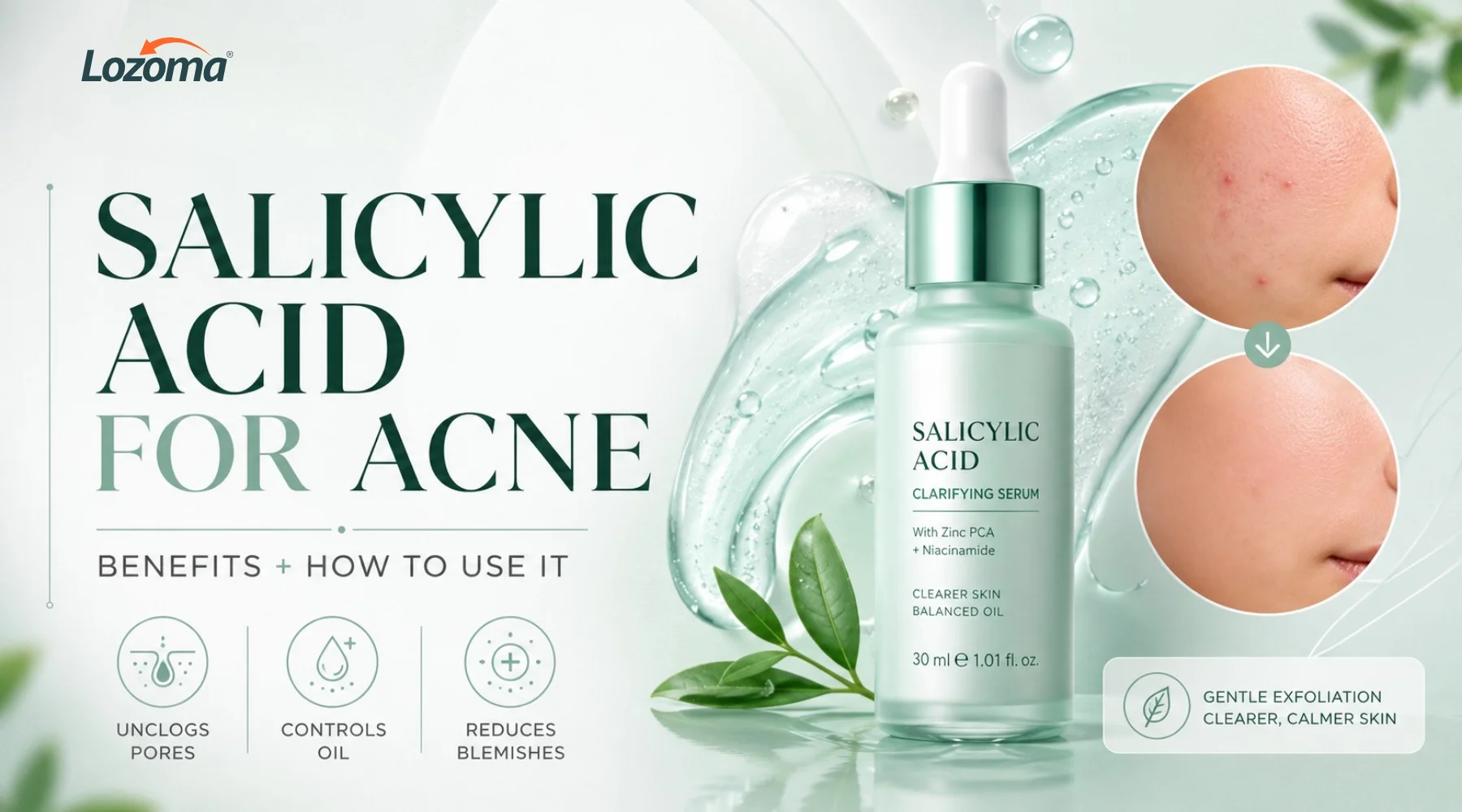 Salicylic Acid for Acne: Benefits and How to Use It Safely